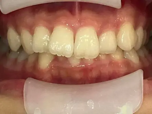 前歯のガタガタが気になるの治療前の画像