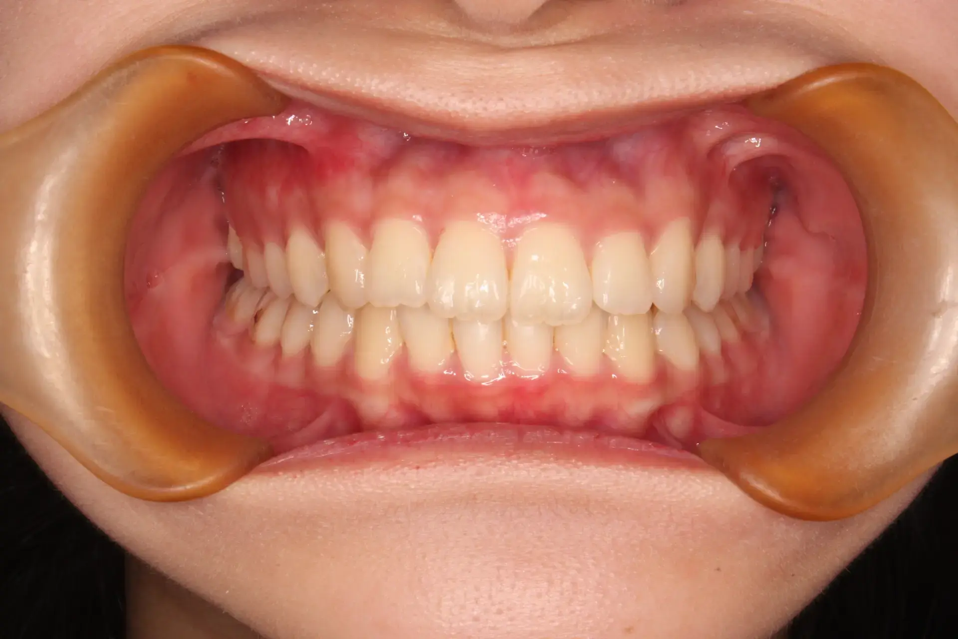 前歯のガタガタが気になるの治療後の画像