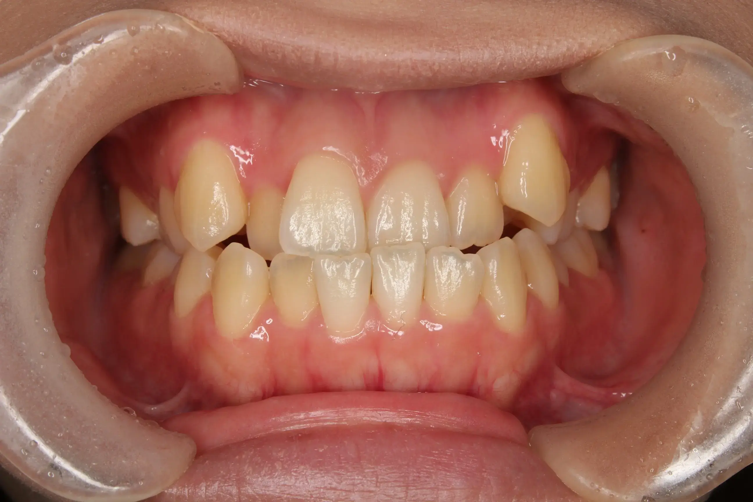 反対咬合を治したいの治療前の画像