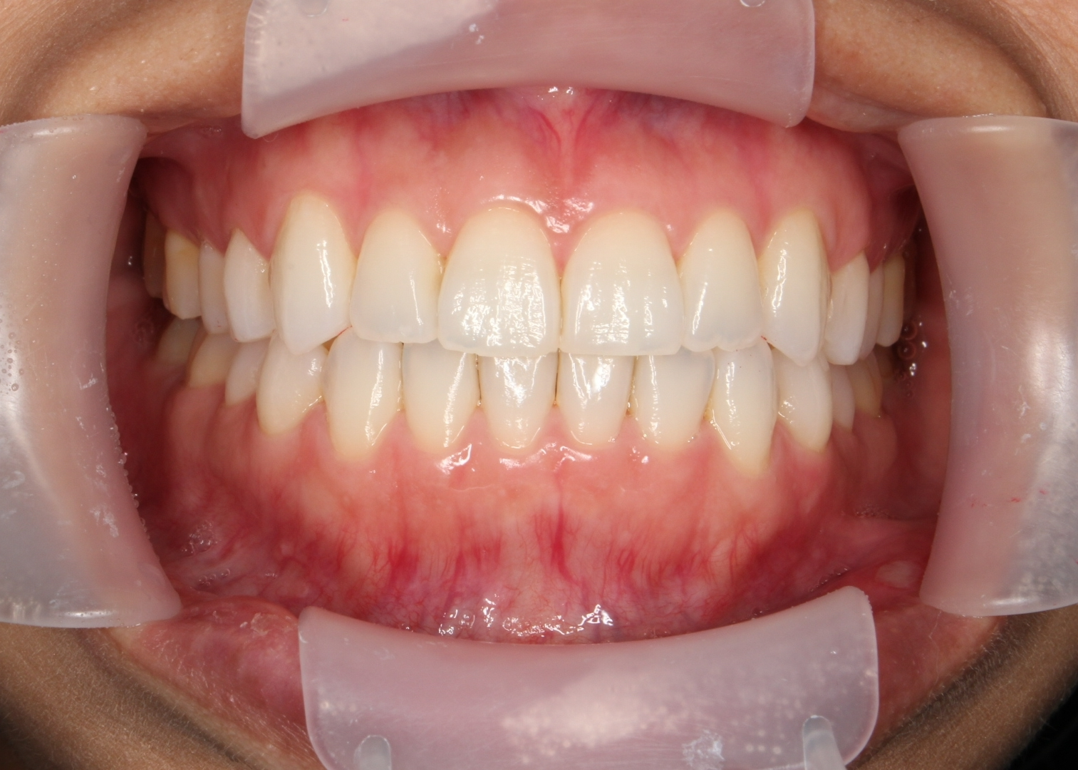 反対咬合を治したいの治療後の画像