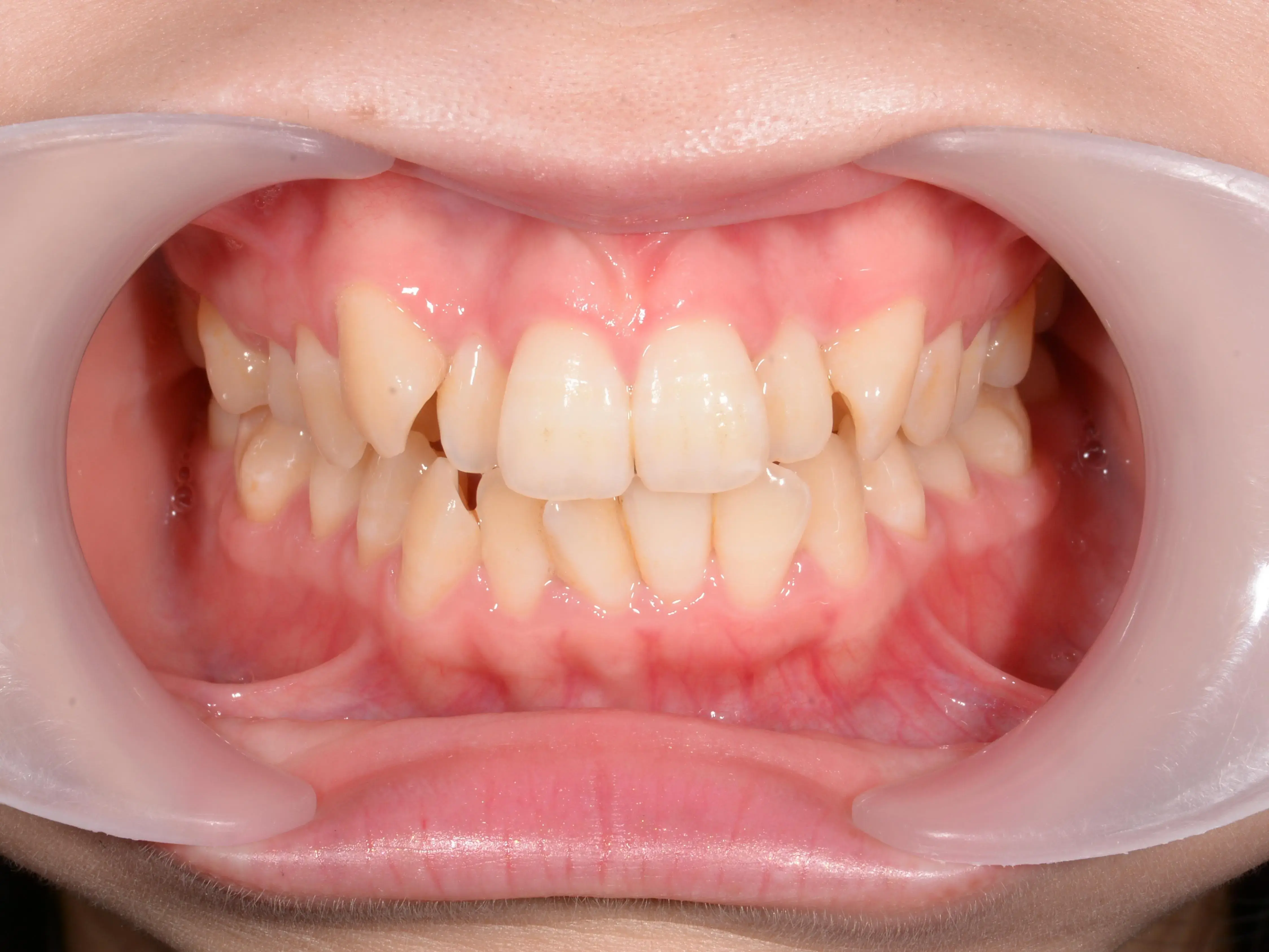 八重歯と上下の歯の中心のずれが気になるの治療前の画像