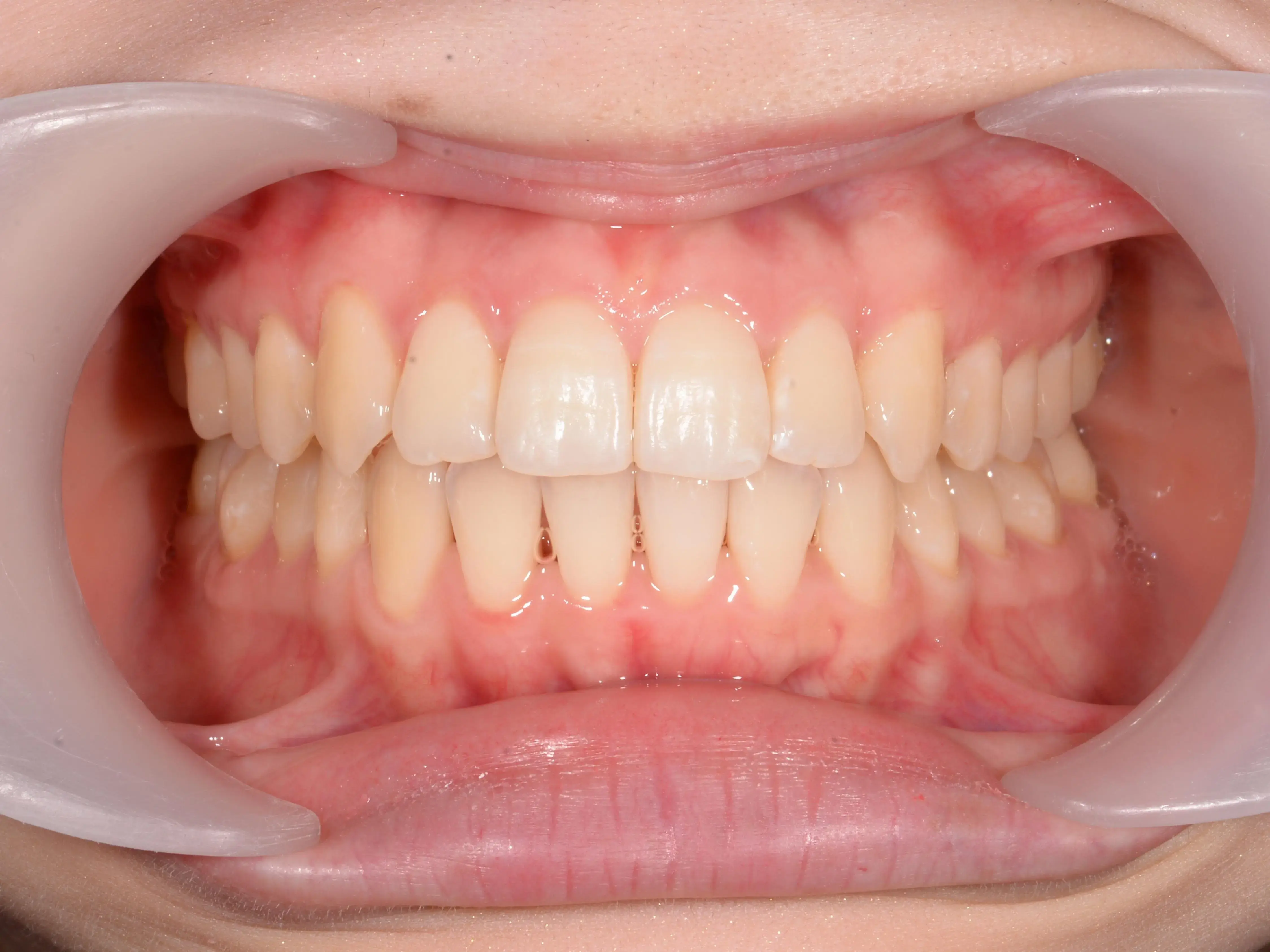 八重歯と上下の歯の中心のずれが気になるの治療後の画像