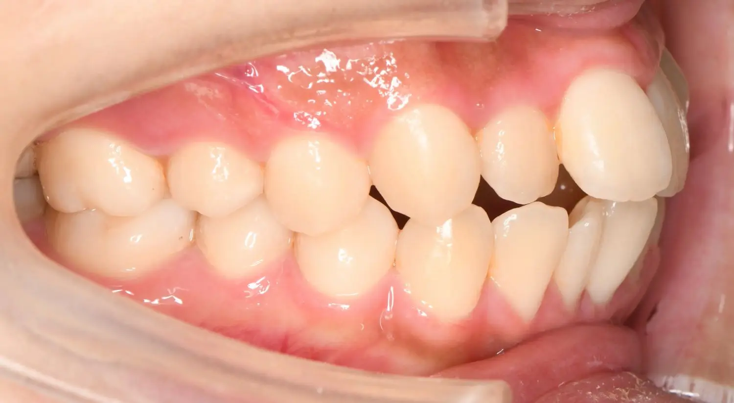 いわゆる「口ゴボ」と言われる、上下の口唇が前方に突出した状態の改善を希望されて来院。また軽度の口唇閉鎖不全も認められ、オトガイ部が筋緊張でくぼんでいることも気になるとのこと。の治療前の画像