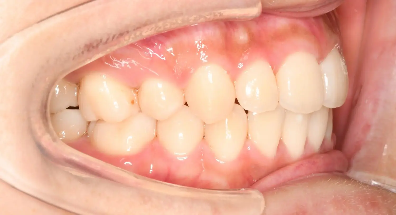 いわゆる「口ゴボ」と言われる、上下の口唇が前方に突出した状態の改善を希望されて来院。また軽度の口唇閉鎖不全も認められ、オトガイ部が筋緊張でくぼんでいることも気になるとのこと。の治療後の画像