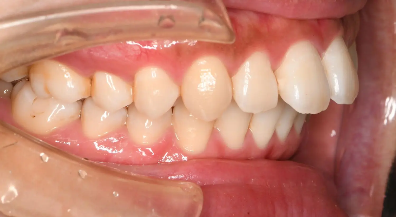 25歳の女性です（治療開始時）。出っ歯や口元が気になるとのことで来院され、カウンセリングを受けられました。の治療前の画像