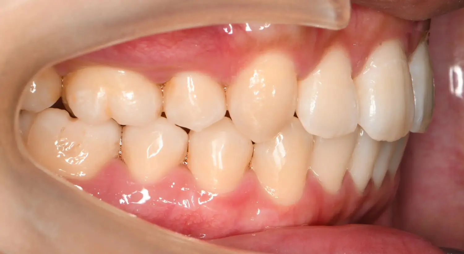 25歳の女性です（治療開始時）。出っ歯や口元が気になるとのことで来院され、カウンセリングを受けられました。の治療後の画像