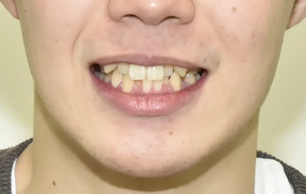 歯のデコボコと八重歯の治療を希望され来院されました。の治療前の画像