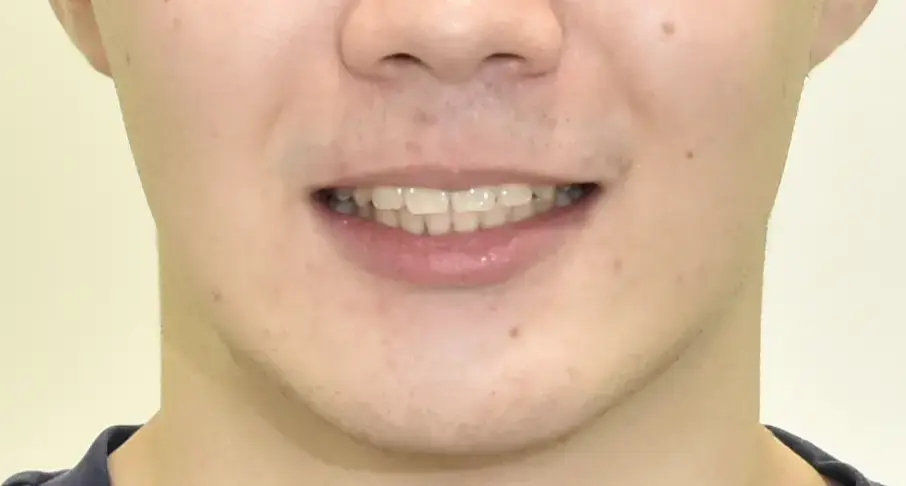 歯のデコボコと八重歯の治療を希望され来院されました。の治療後の画像