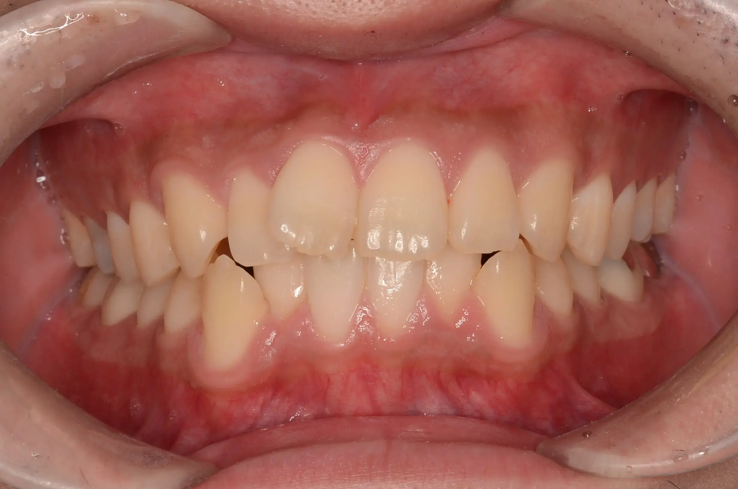 歯全体の凸凹と口元の突出感の治療前の画像