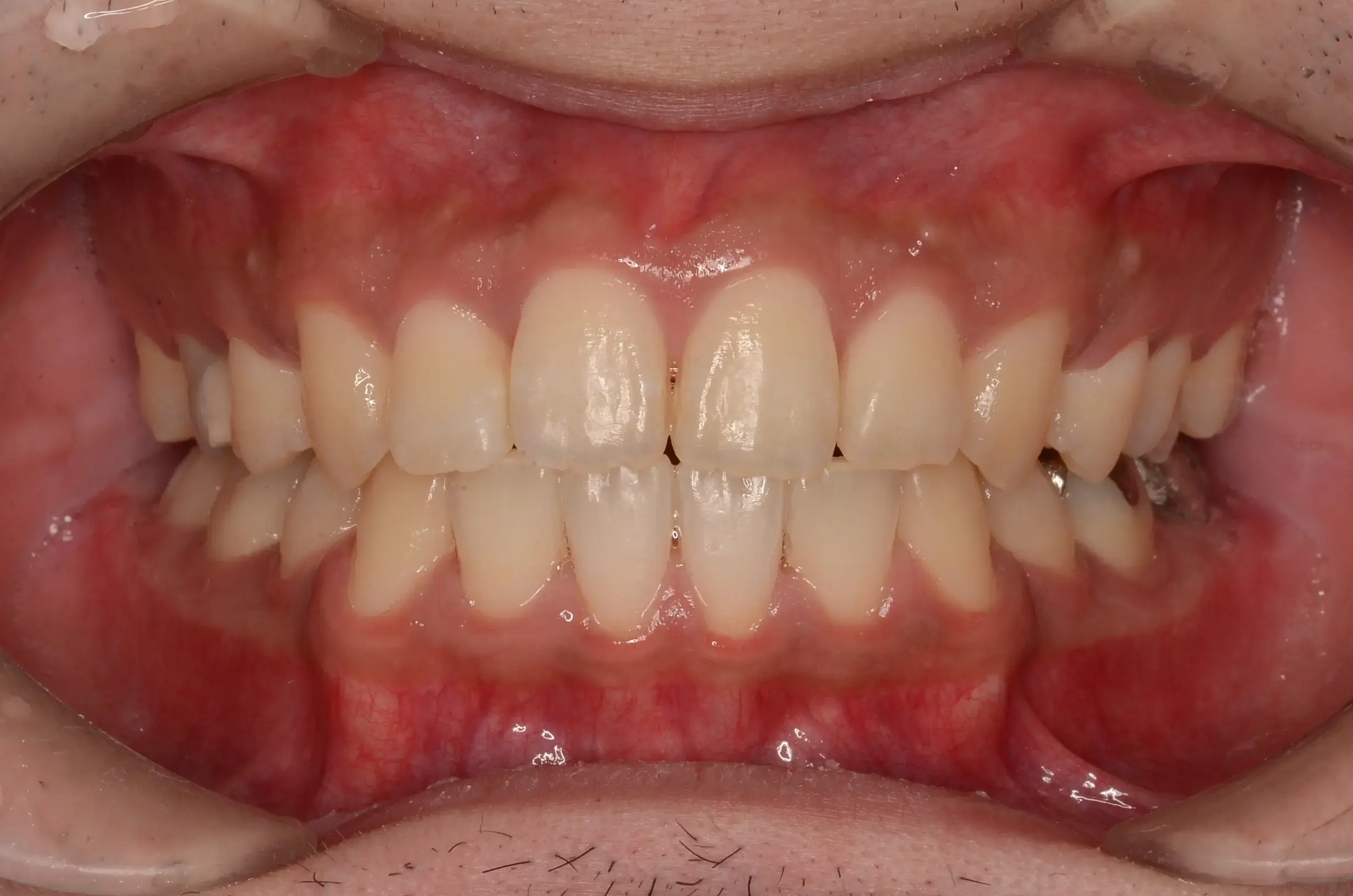 歯全体の凸凹と口元の突出感の治療後の画像