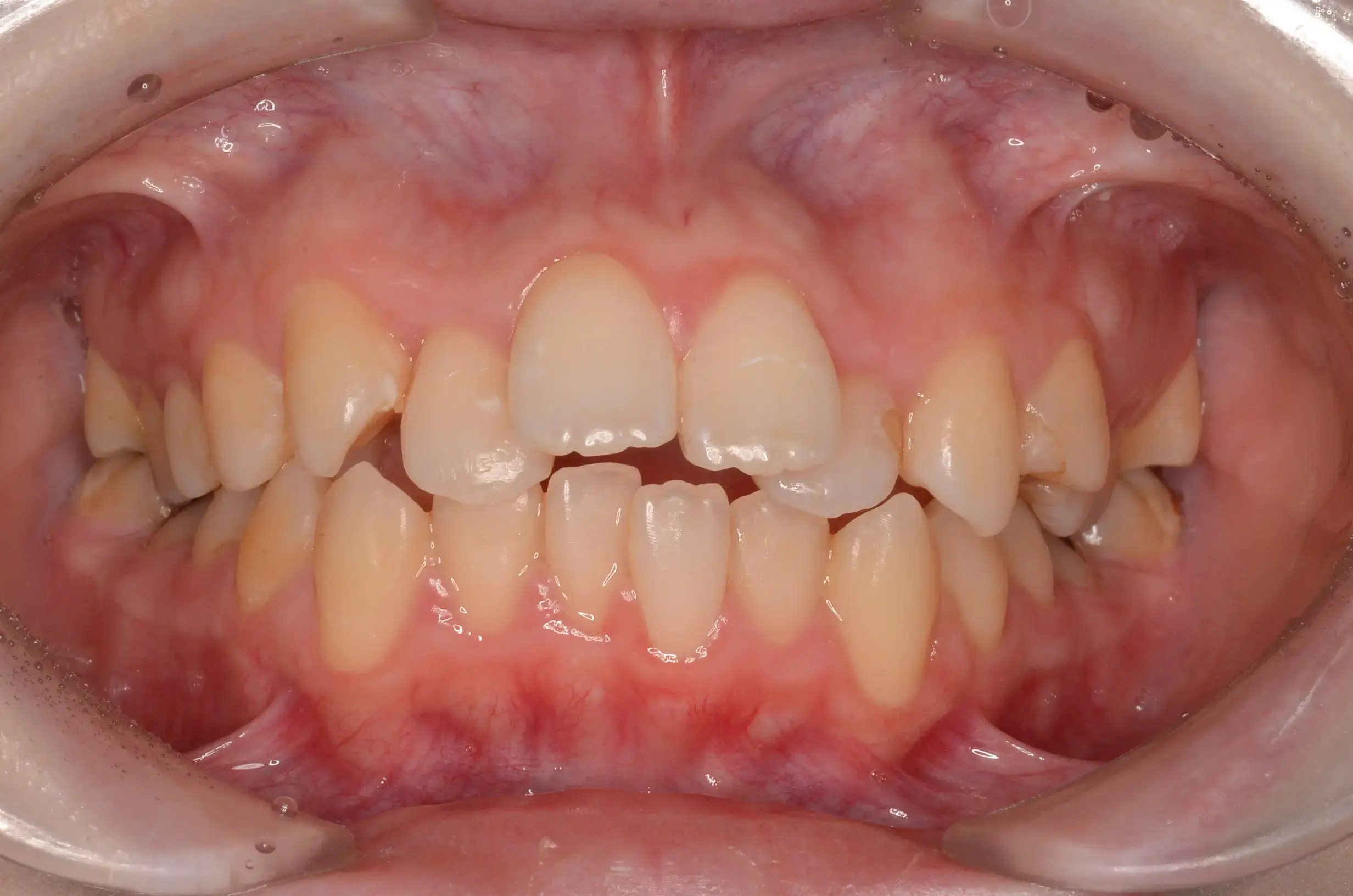 歯全体の凸凹と前歯で咬めないの治療前の画像