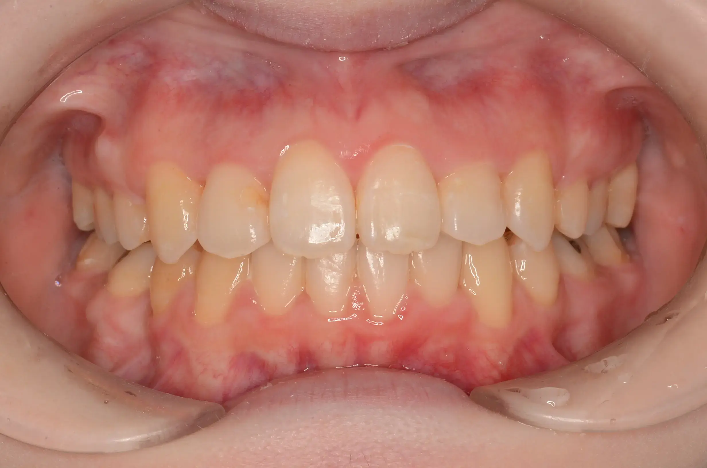 歯全体の凸凹と前歯で咬めないの治療後の画像