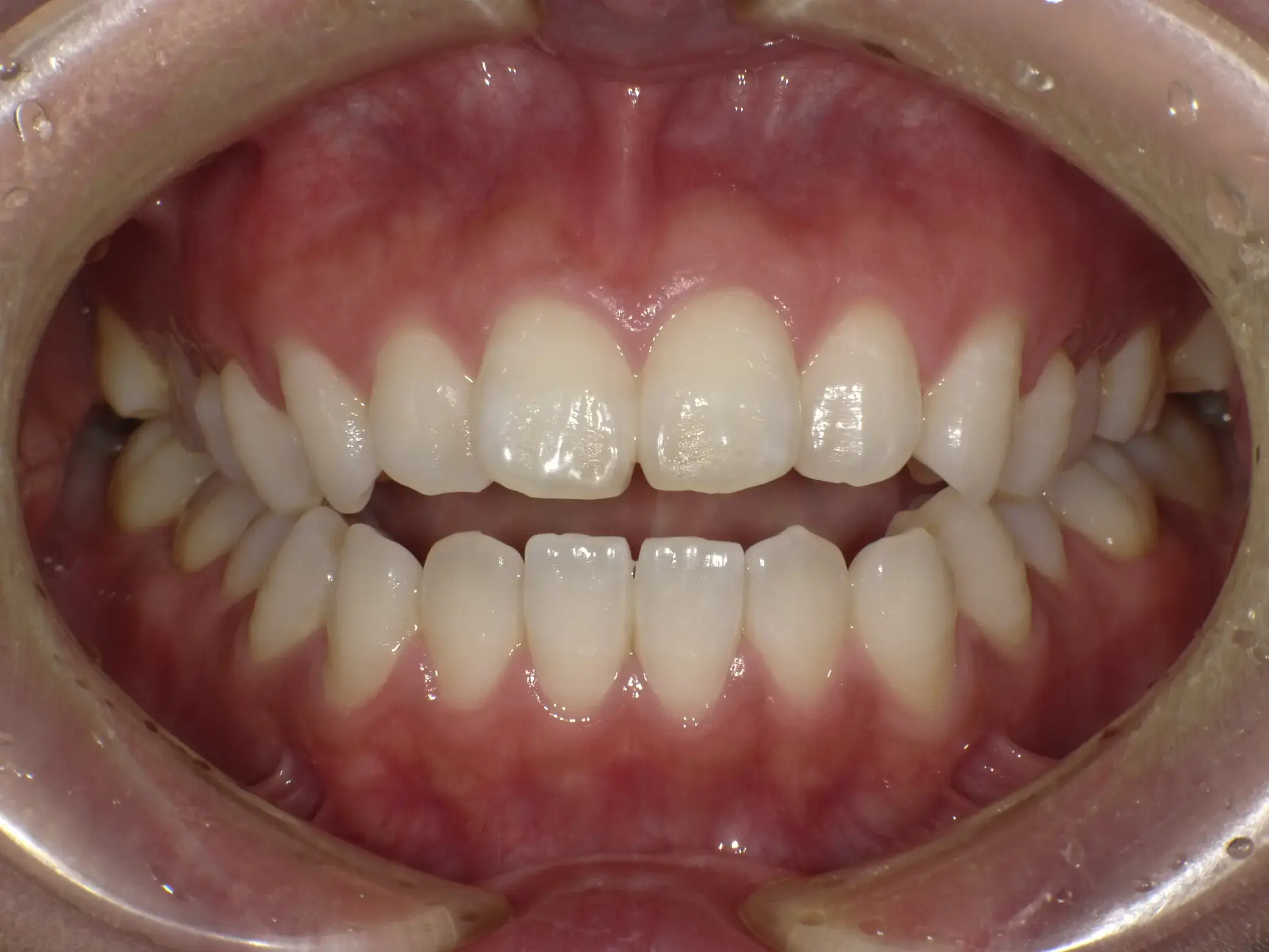 前歯で食べ物が咬めないの治療前の画像