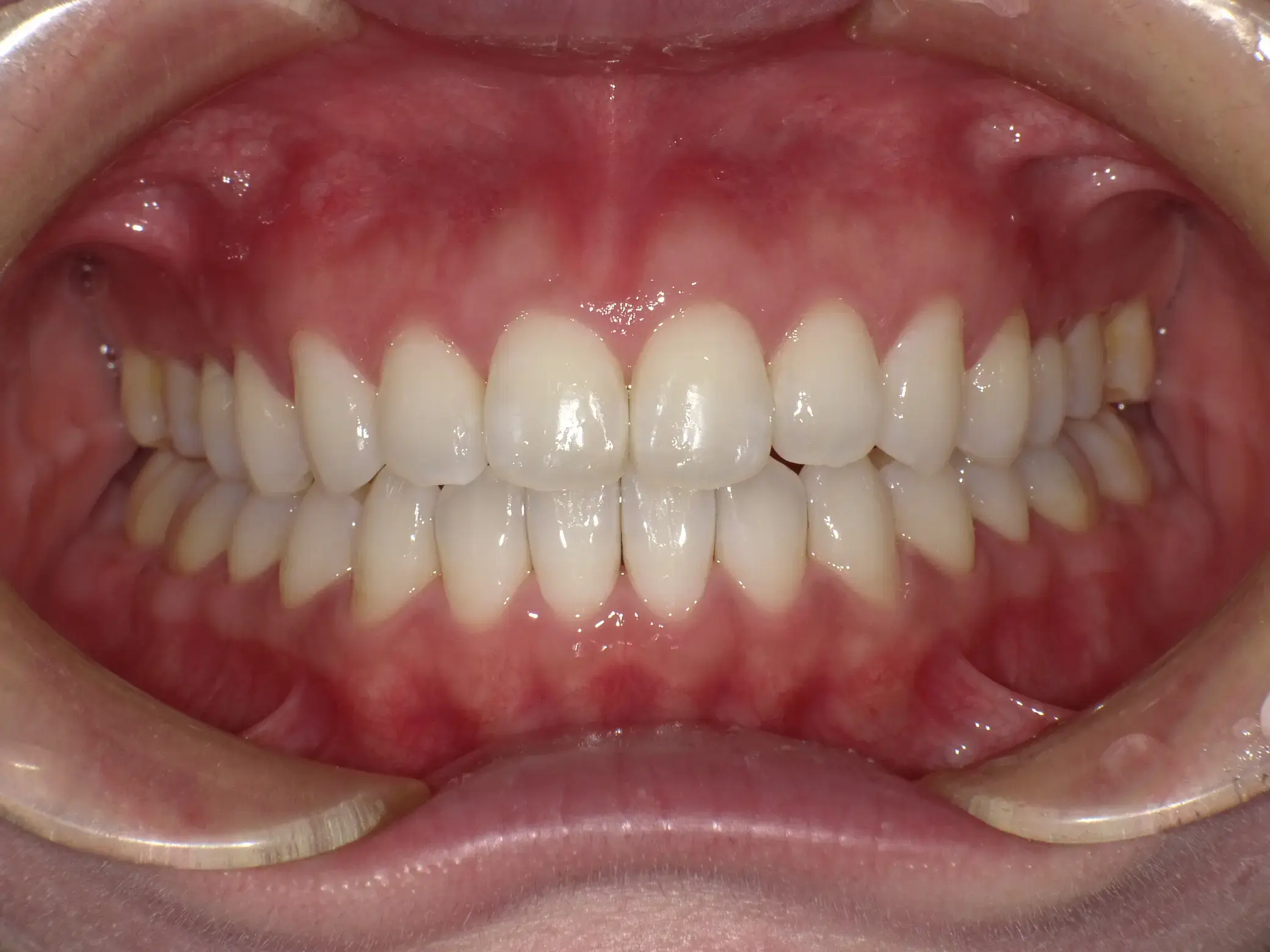 前歯で食べ物が咬めないの治療後の画像