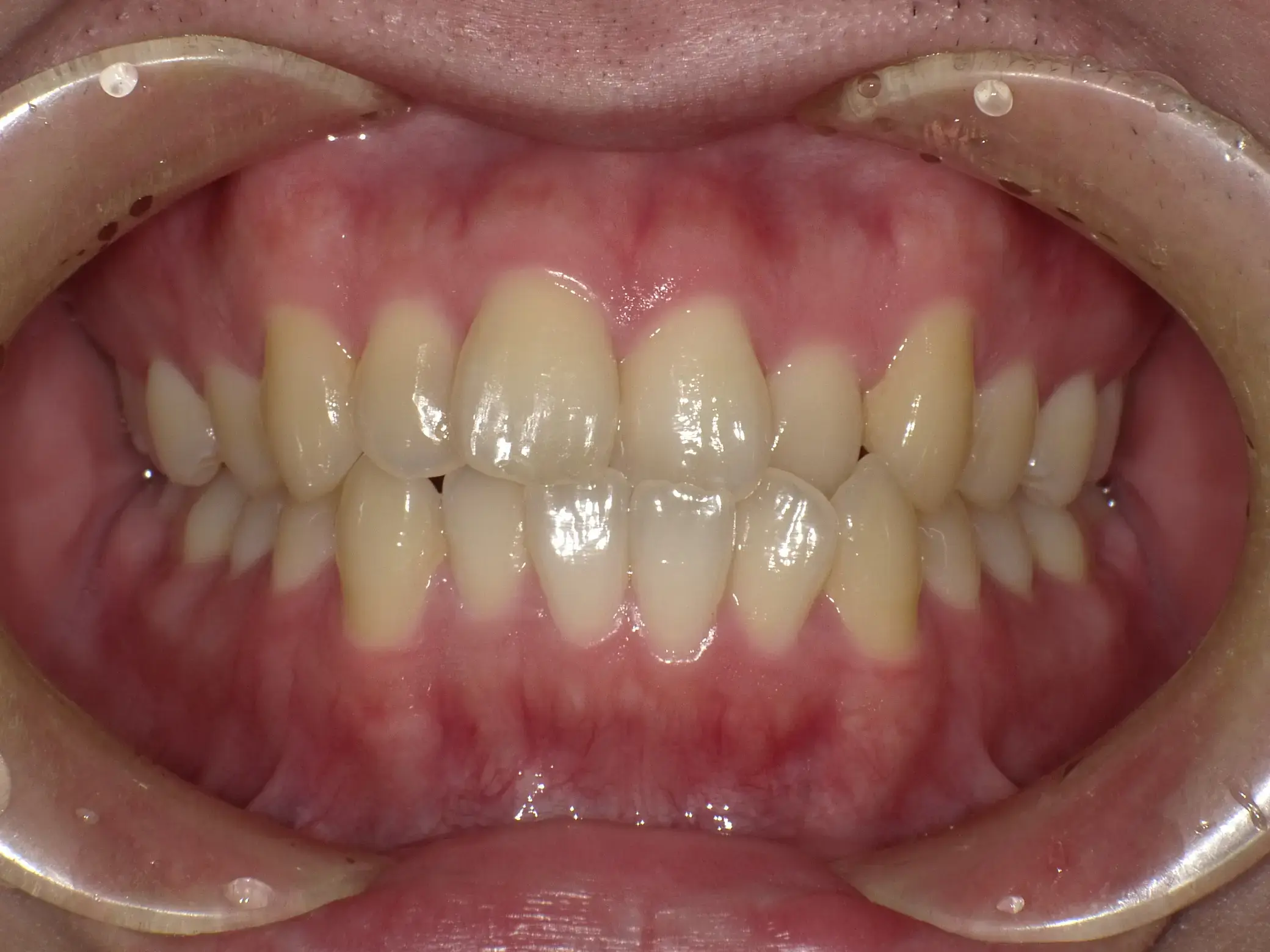 前歯の凸凹、咬み合わせが逆になっている部分があるの治療前の画像