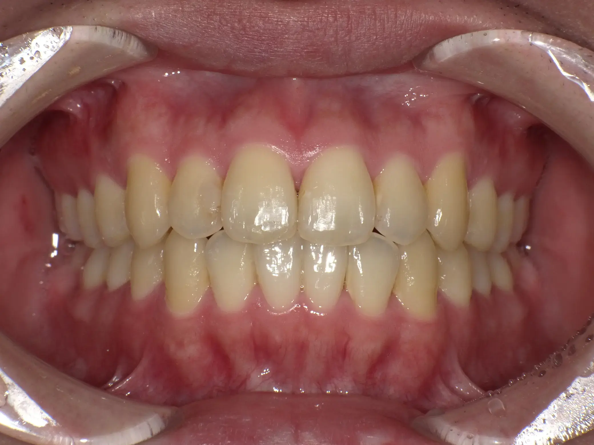 前歯の凸凹、咬み合わせが逆になっている部分があるの治療後の画像