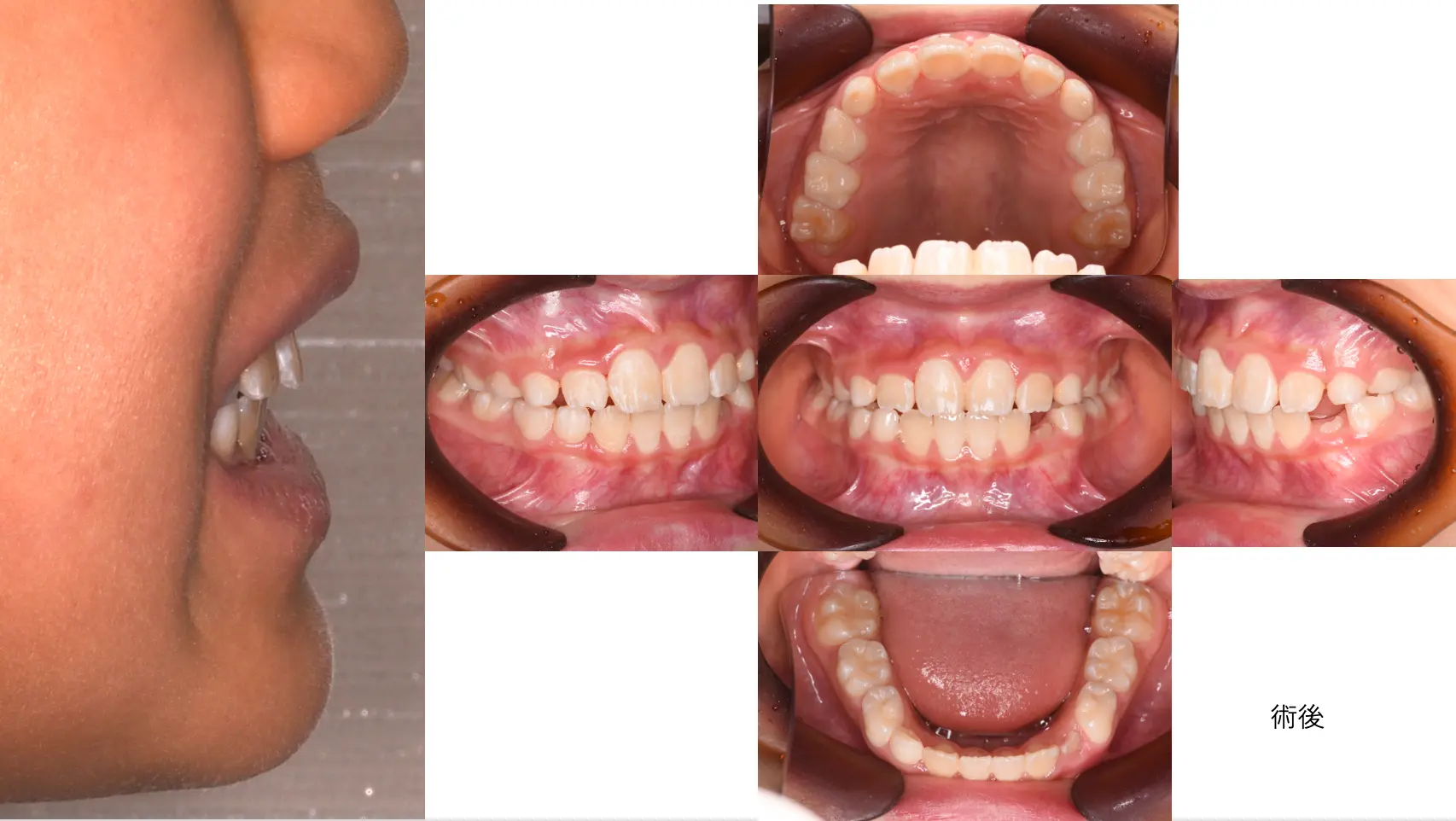 インビザラインの症例 治療後の画像