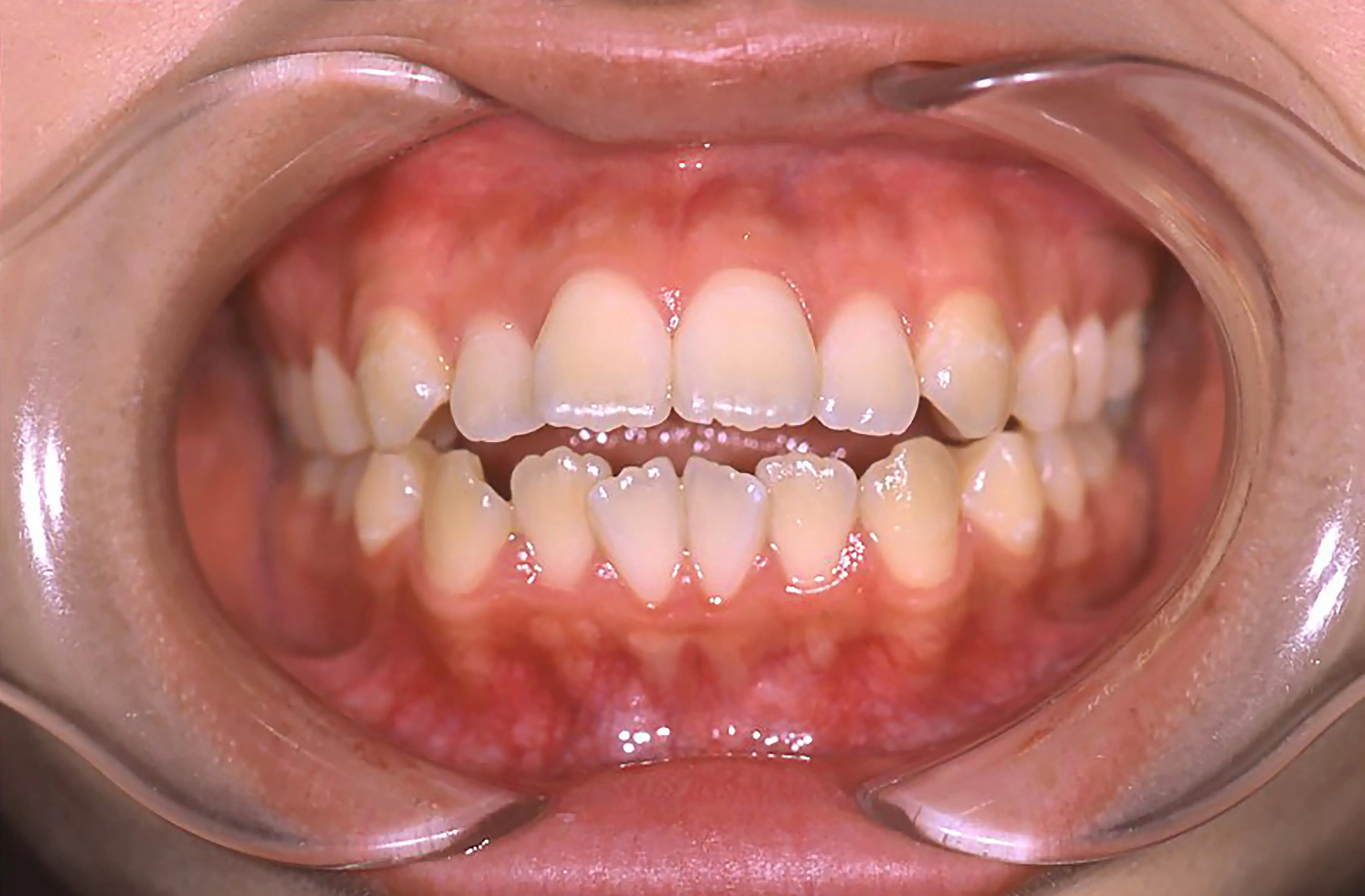 表側矯正の症例1の治療前の画像