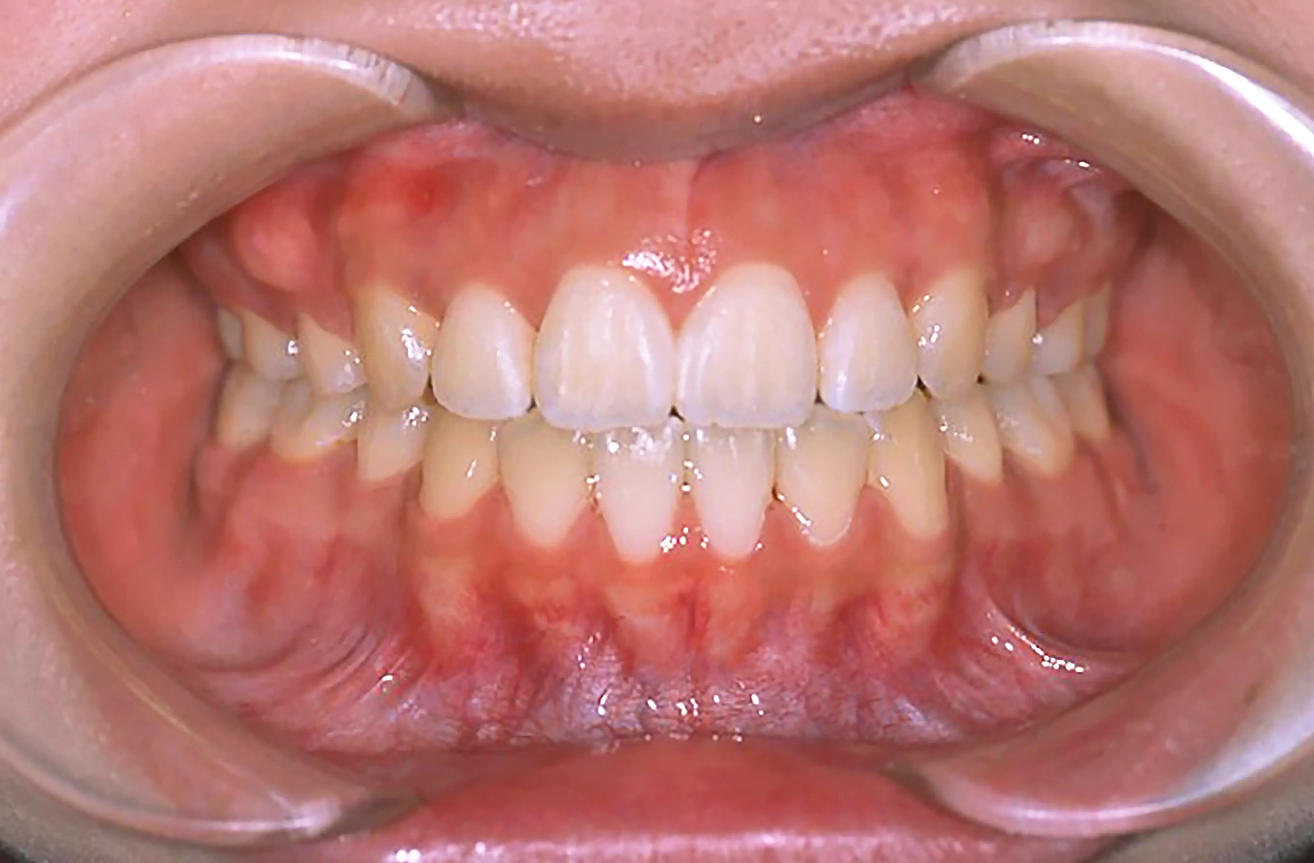 表側矯正の症例1の治療後の画像