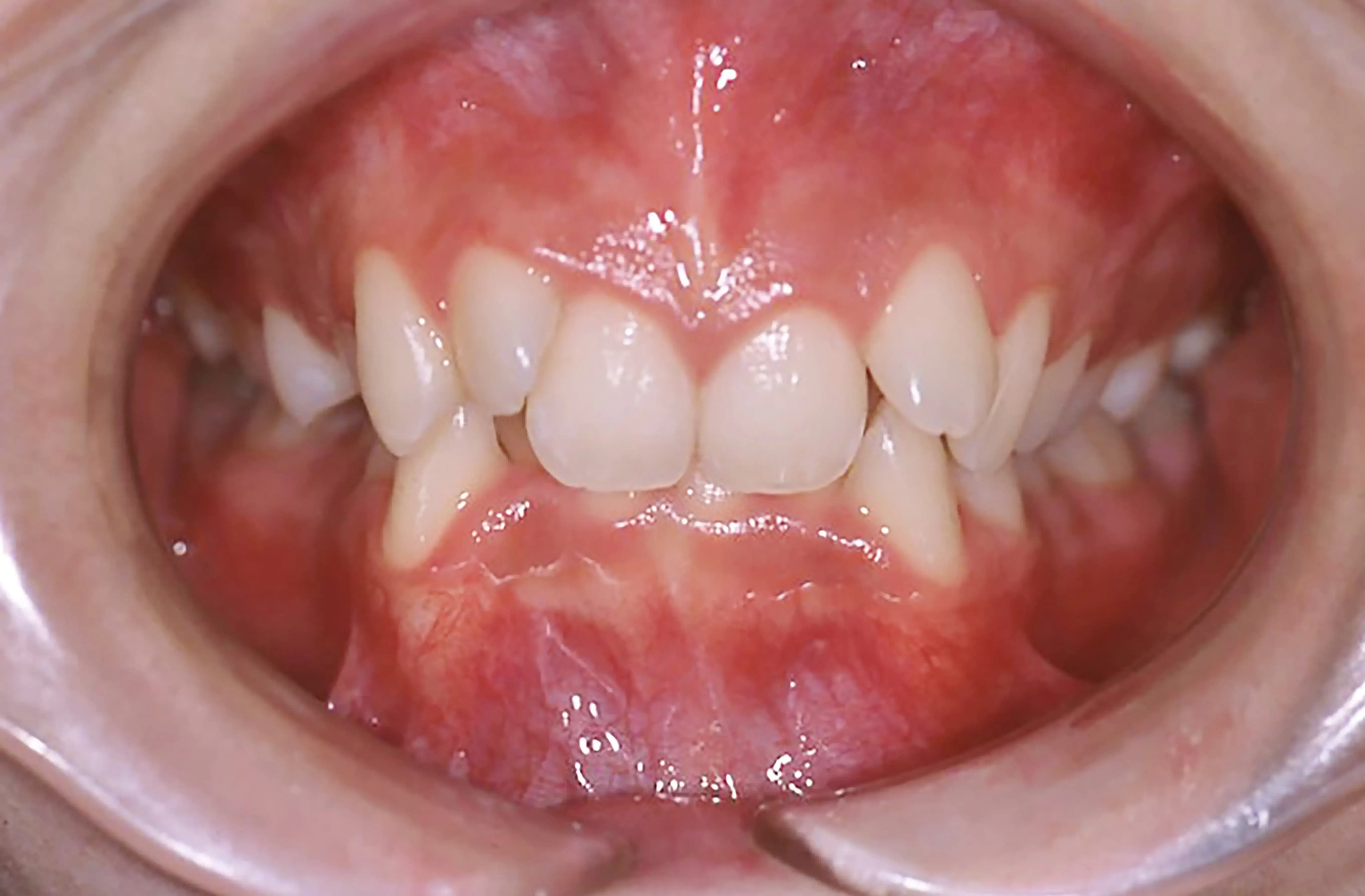 表側矯正の症例2の治療前の画像