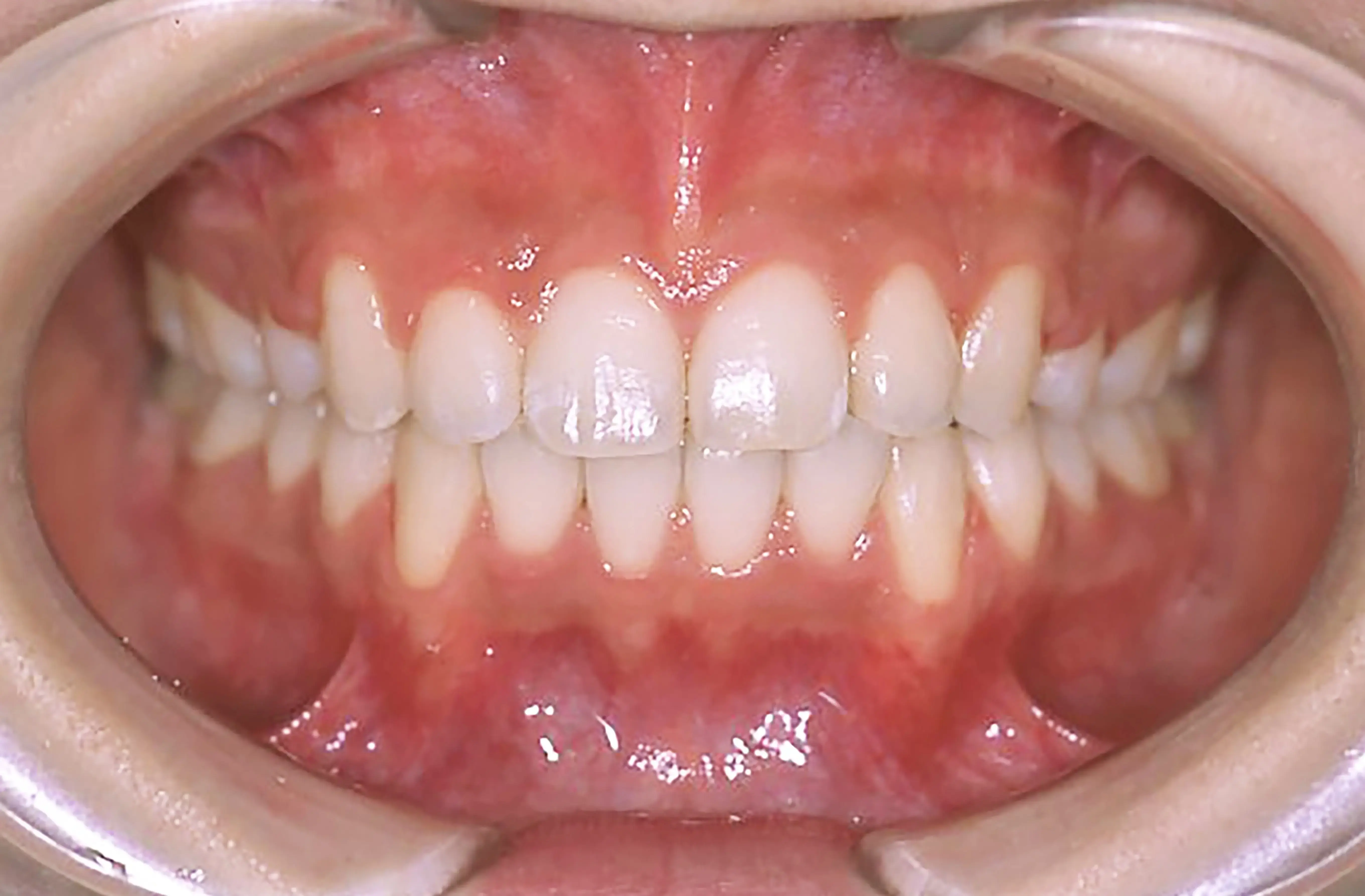 表側矯正の症例2の治療後の画像