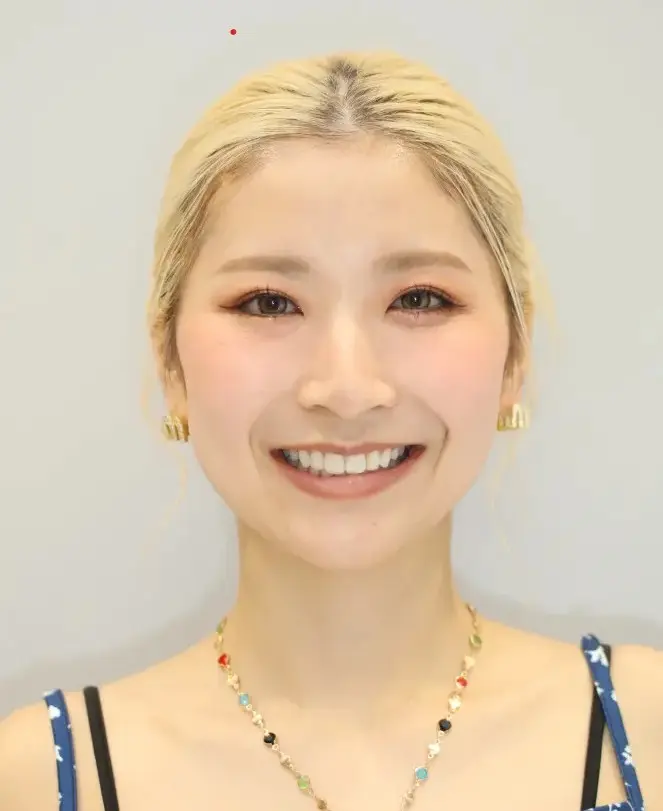 口元の突出感（口ゴボ）を改善したい。横顔のバランスを整え、Eラインをきれいにしたいの治療後の画像