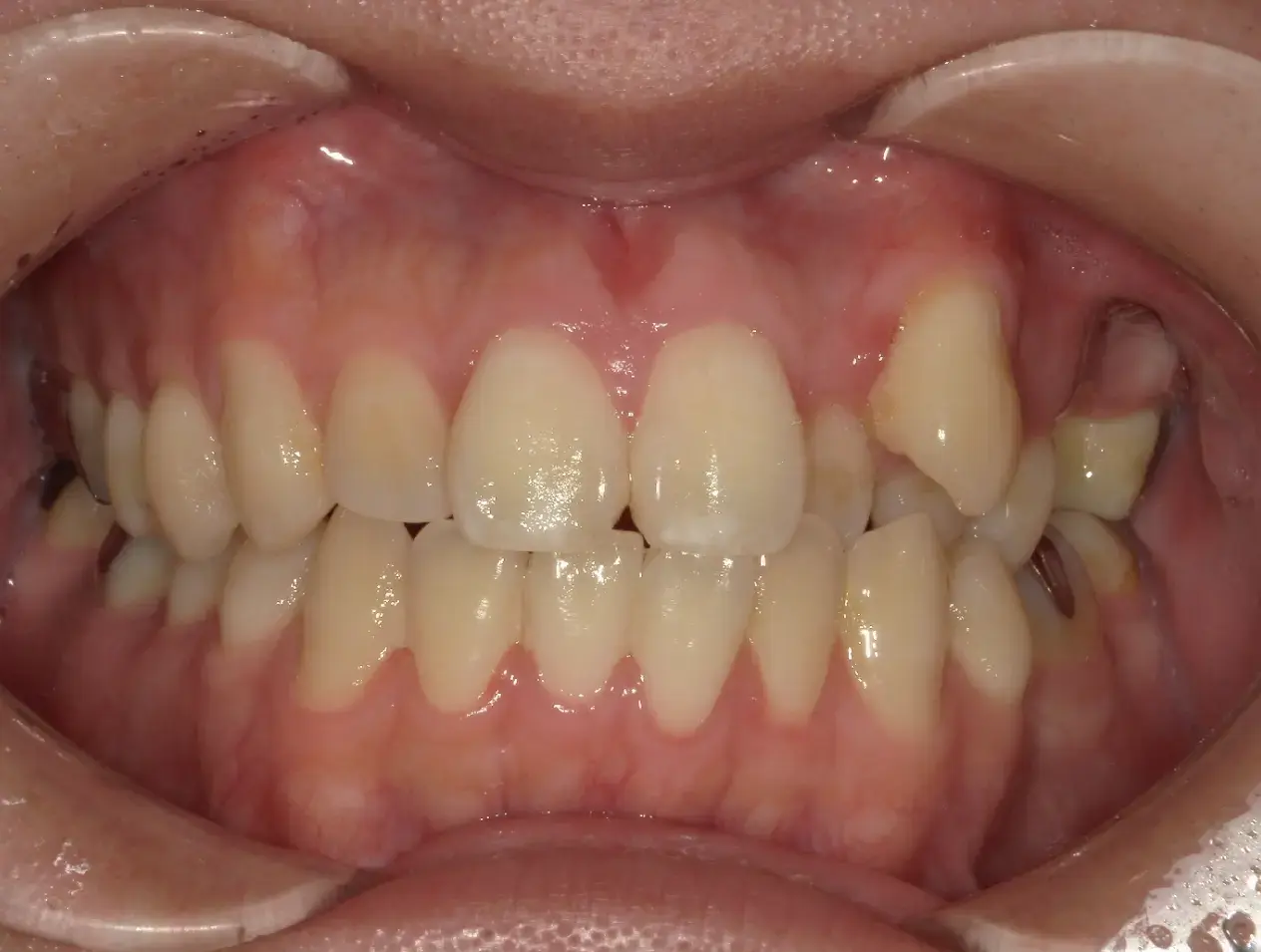 八重歯や歯のがたつきを改善し、咬み合わせも含めて歯並び全体を整えたい。できるだけ目立たない装置で矯正治療を行いたいの治療前の画像