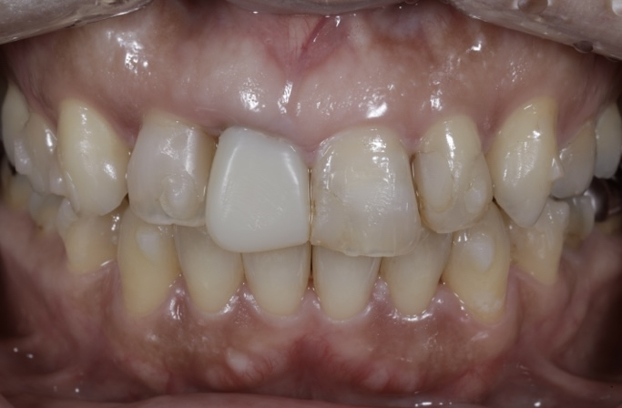 差し歯のところが痛む（ブリッジが困難なため前歯のみ部分矯正）の治療前の画像
