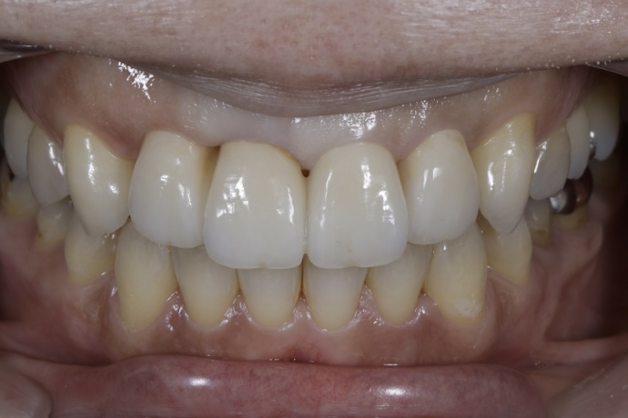 差し歯のところが痛む（ブリッジが困難なため前歯のみ部分矯正）の治療後の画像