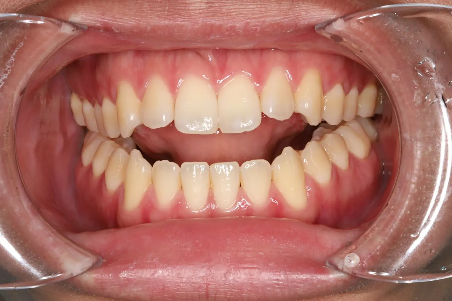 前歯でモノが噛めないの治療前の画像