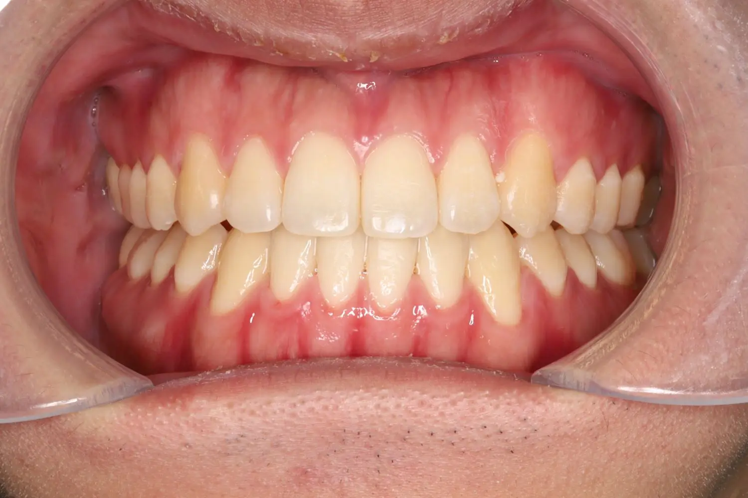 前歯でモノが噛めないの治療後の画像