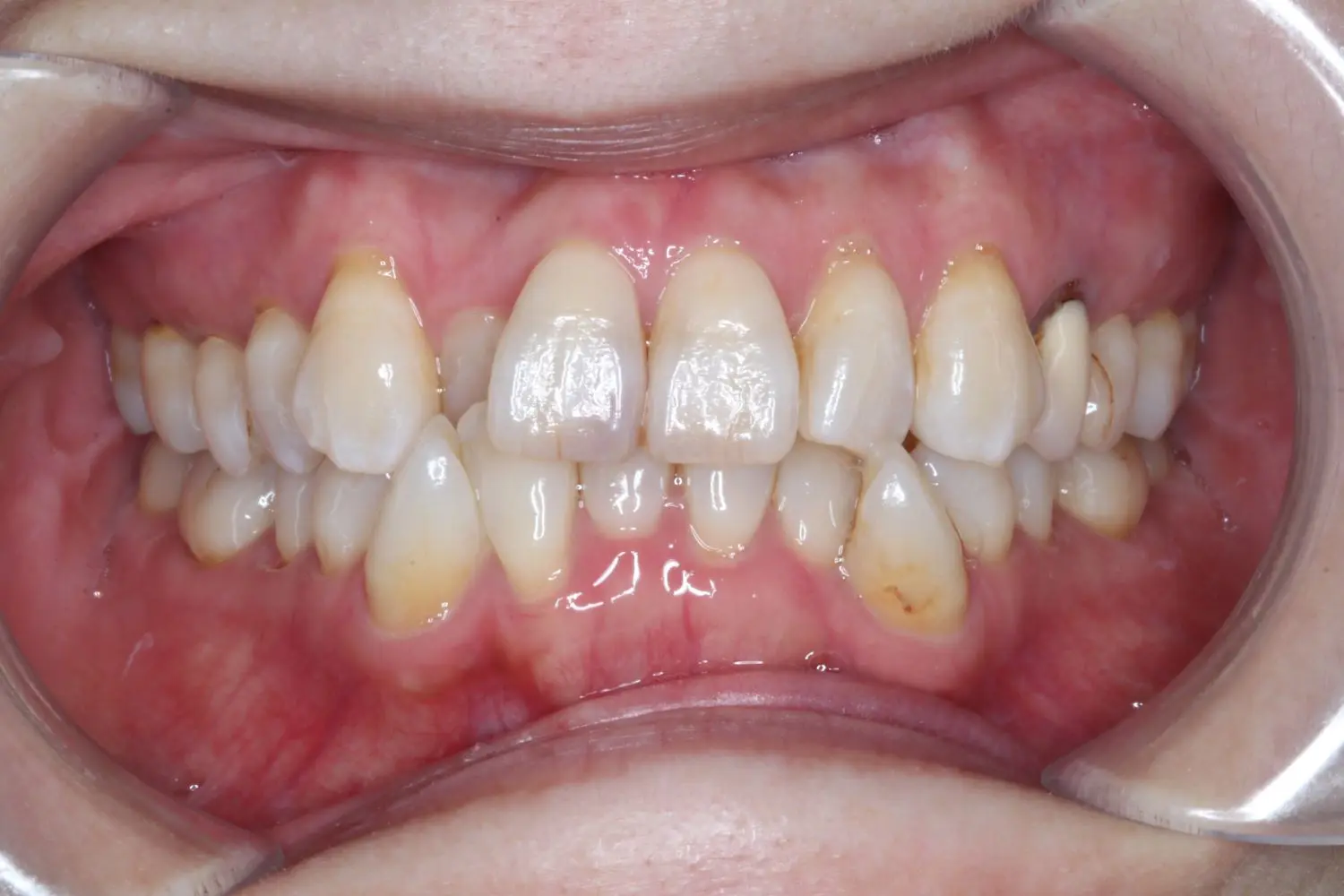 ガタガタの治療前の画像