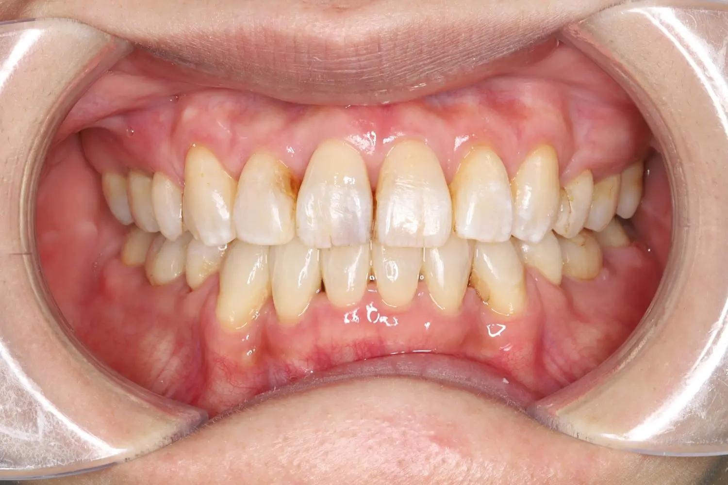 ガタガタの治療後の画像