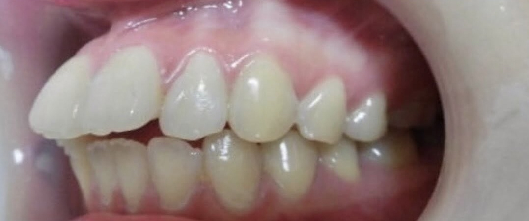 インビザラインの症例 治療前の画像