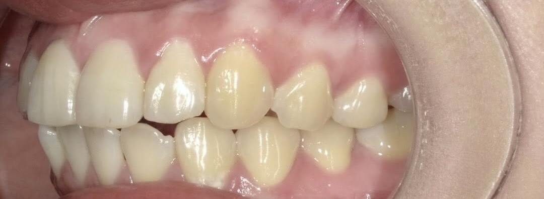 インビザラインの症例 治療後の画像