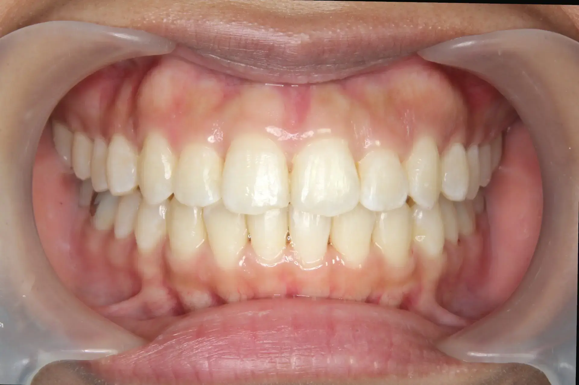 インビザラインの症例 治療後の画像