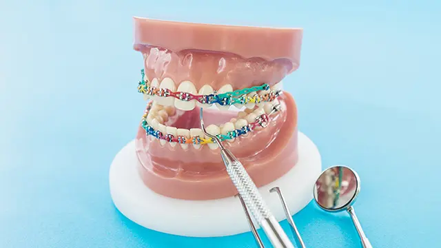 そもそもアンカースクリューとは？矯正治療での役割の画像