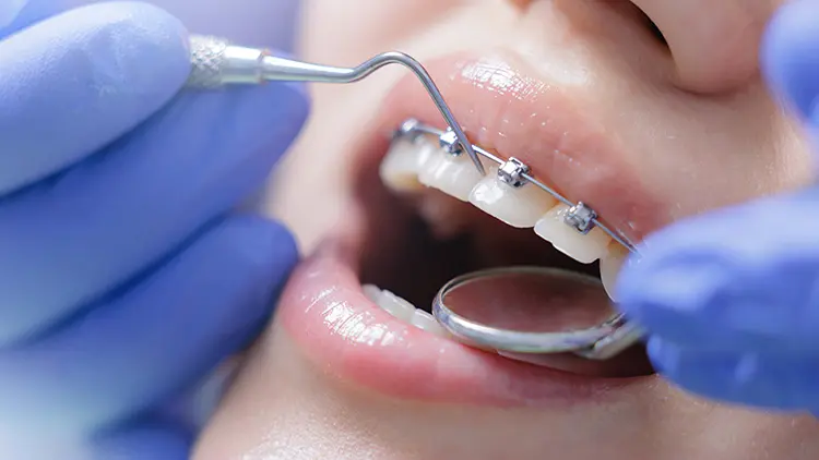 根本的な隙間解消には歯列矯正が有効な選択肢の画像