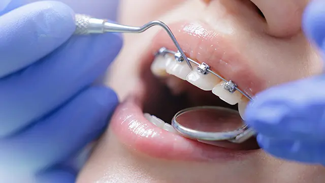 根本的な隙間解消には歯列矯正が有効な選択肢の画像