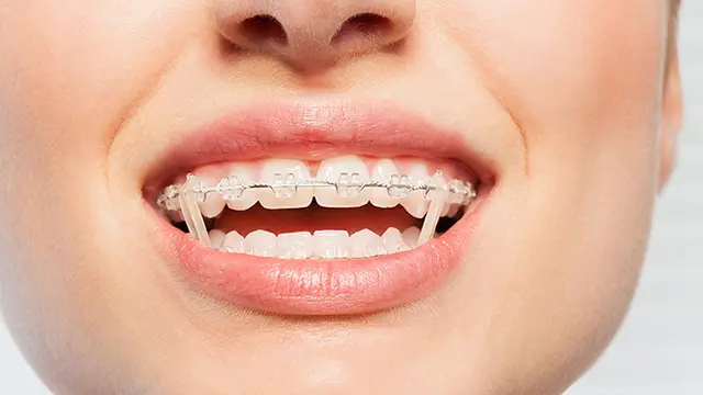 最終段階のゴムかけは噛み合わせの微調整の画像