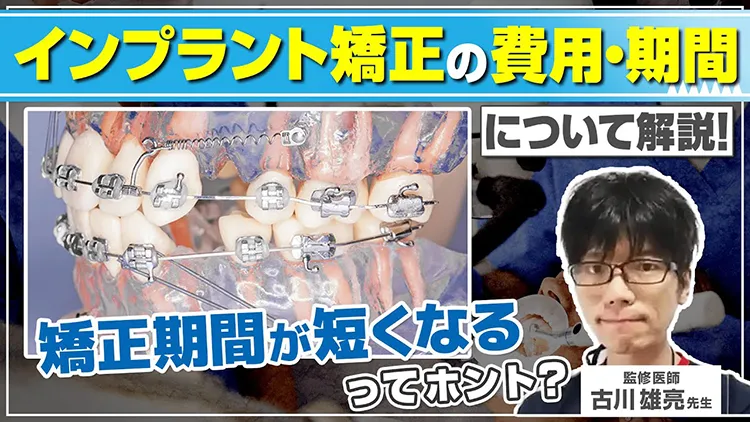 インプラント矯正の費用は?期間やメリットも紹介!のサムネイル画像