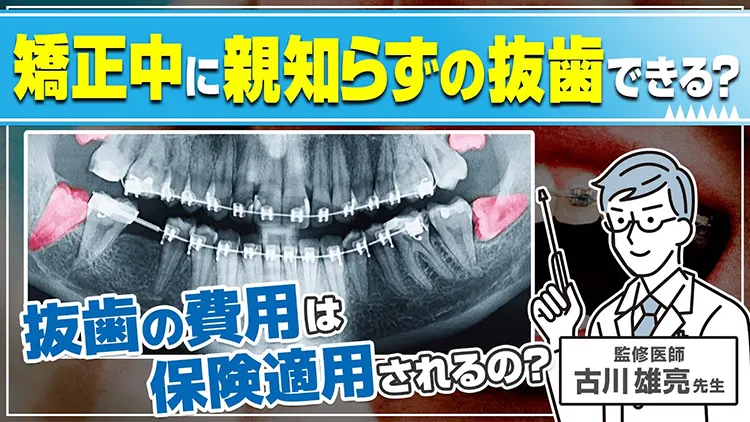 矯正中に親知らずが生えてきた!治療中でも保険適用で抜歯できる?のサムネイル画像