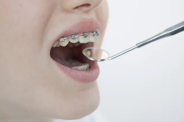 矯正中に大切な虫歯の予防方法3選の画像