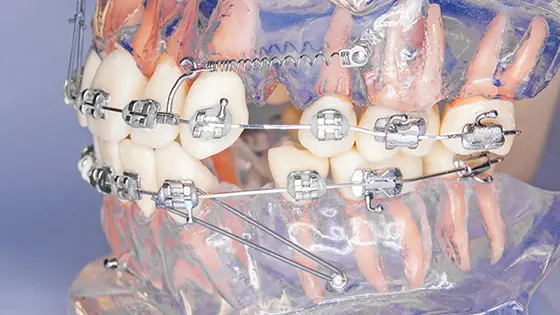 アンカースクリューでおすすめの矯正歯科医院の画像