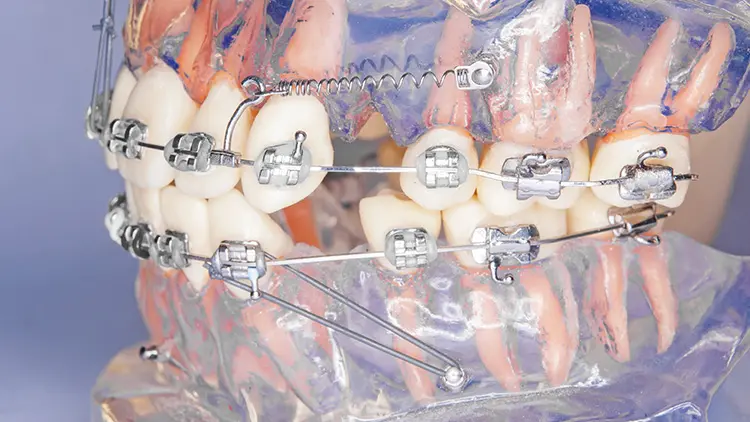 アンカースクリューとは？の画像