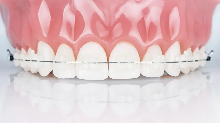 審美ブラケットとは？の画像