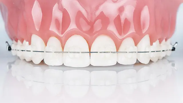 審美ブラケットとは？の画像