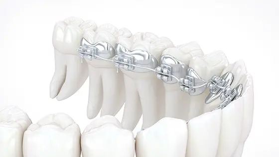 裏側矯正でおすすめの矯正歯科医院の画像
