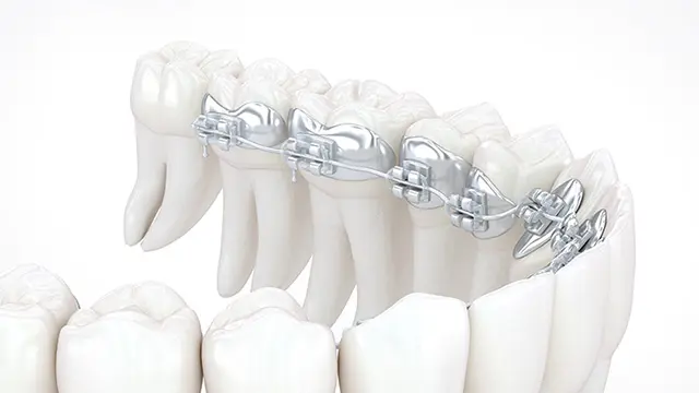 裏側矯正とは？の画像