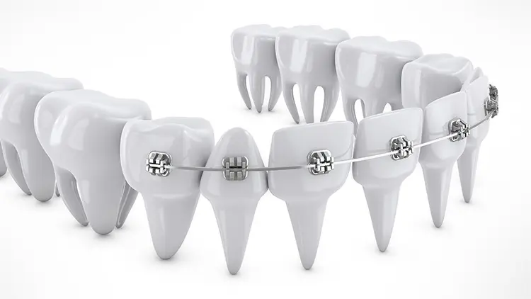 部分矯正とは？の画像